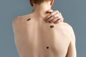 A man displaying his bare back highlighting moles on his back.