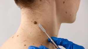 Close-up of human skin showing a large, irregularly shaped dark mole with uneven borders and varying colors, potentially indicative of melanoma.