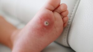 Child’s foot with a plantar wart, commonly treated in pediatric wart removal procedures