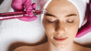 Woman receiving a professional microneedling treatment at a dermatology clinic, promoting smoother and rejuvenated skin