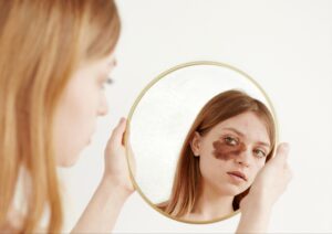 Young woman holding a round mirror, reflecting her face with a large, dark birthmark or hyperpigmentation on her left cheek, looking at her reflection with a neutral expression.