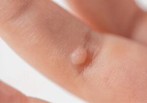 Close-up of a wart on a person's finger, showing a small, raised, rough-textured skin growth.